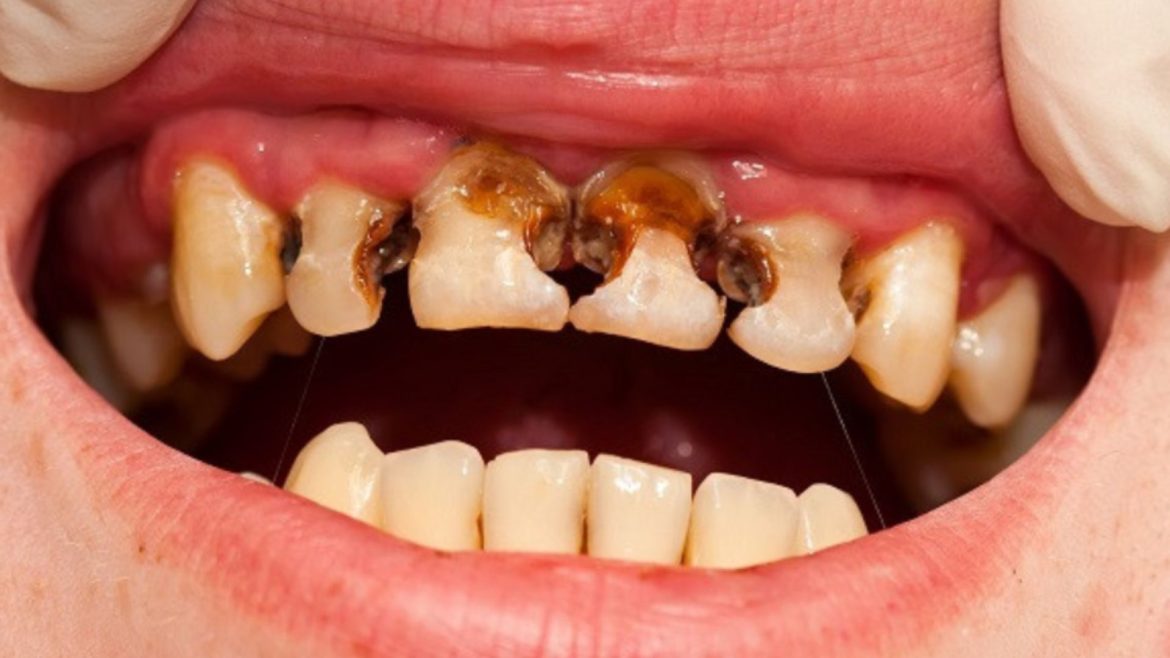 Viêm tủy răng -1